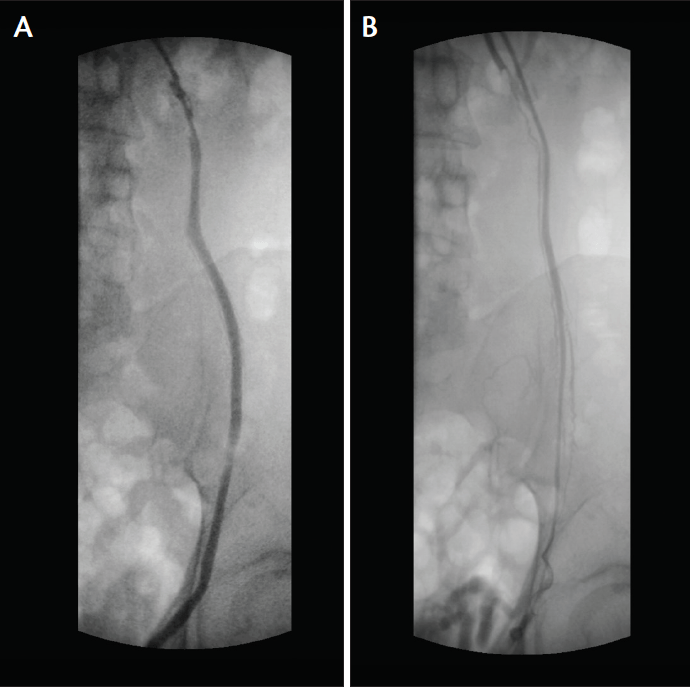 Endovascular Today Varicocele Embolization for Infertility (April 2017)
