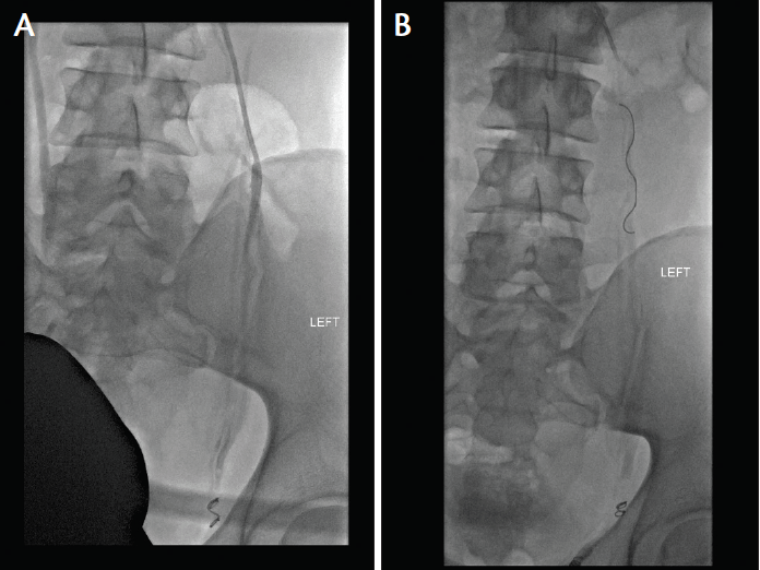 Varicocele Embolization for Infertility Endovascular Today