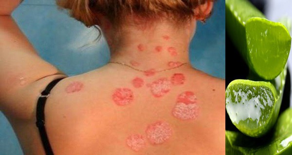 L'Aloe Vera est un puissant traitement de l'eczéma, le