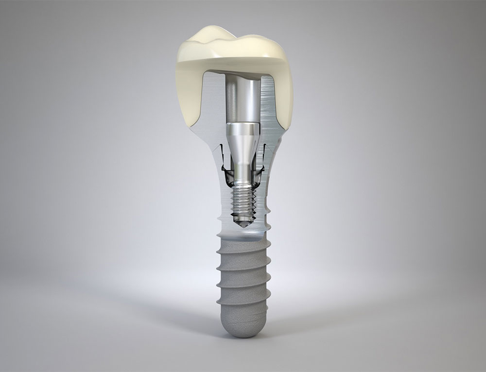 Straumann We Know Smiles