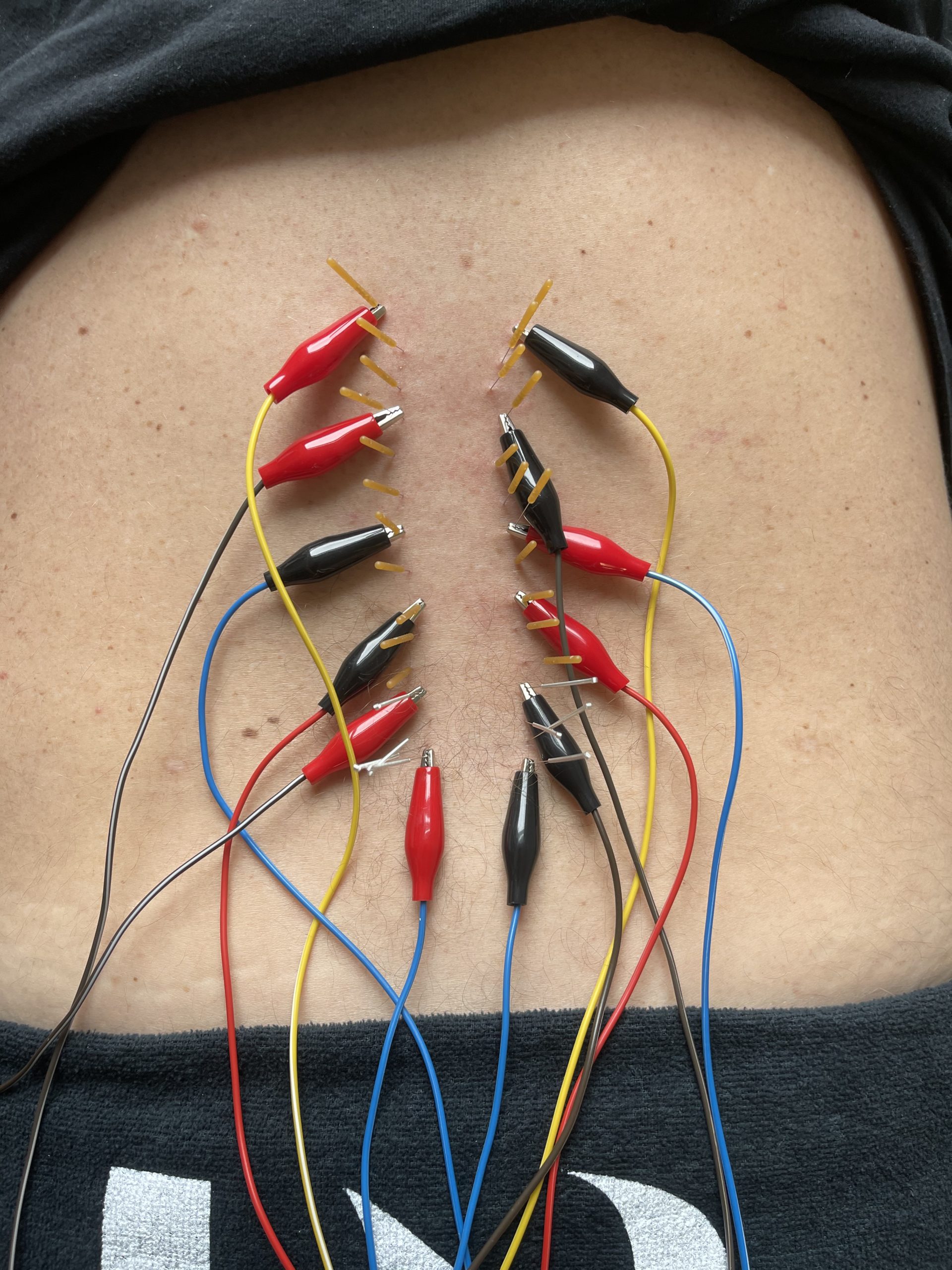 Can Dry Needling Help My Sciatica? Executive PT