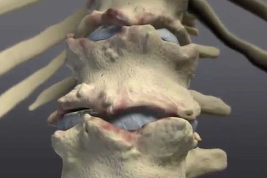 Hackettstown Ankylosing Spondylitis Treatment & Symptoms ESS