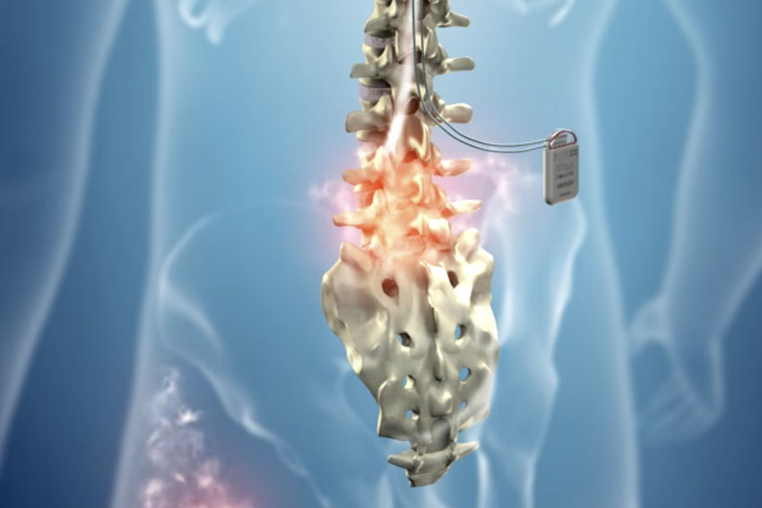 High Frequency Stimulation Carl Spivak, MD Executive Spine Surgery