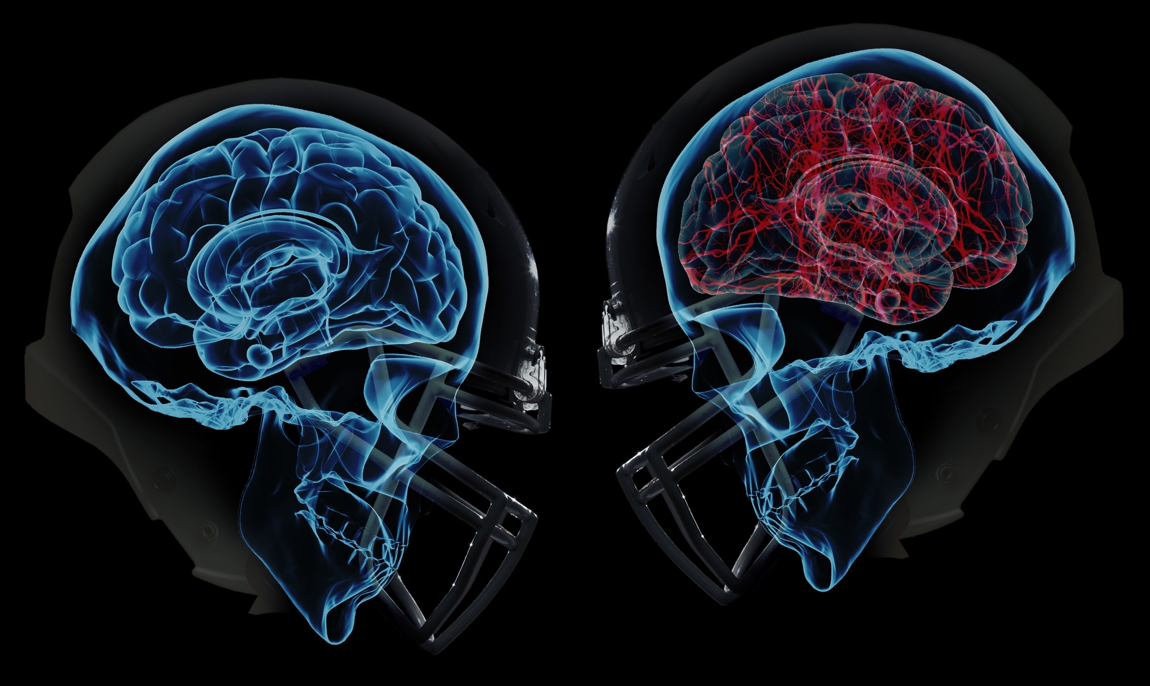 Concussion Johns Hopkins Medicine