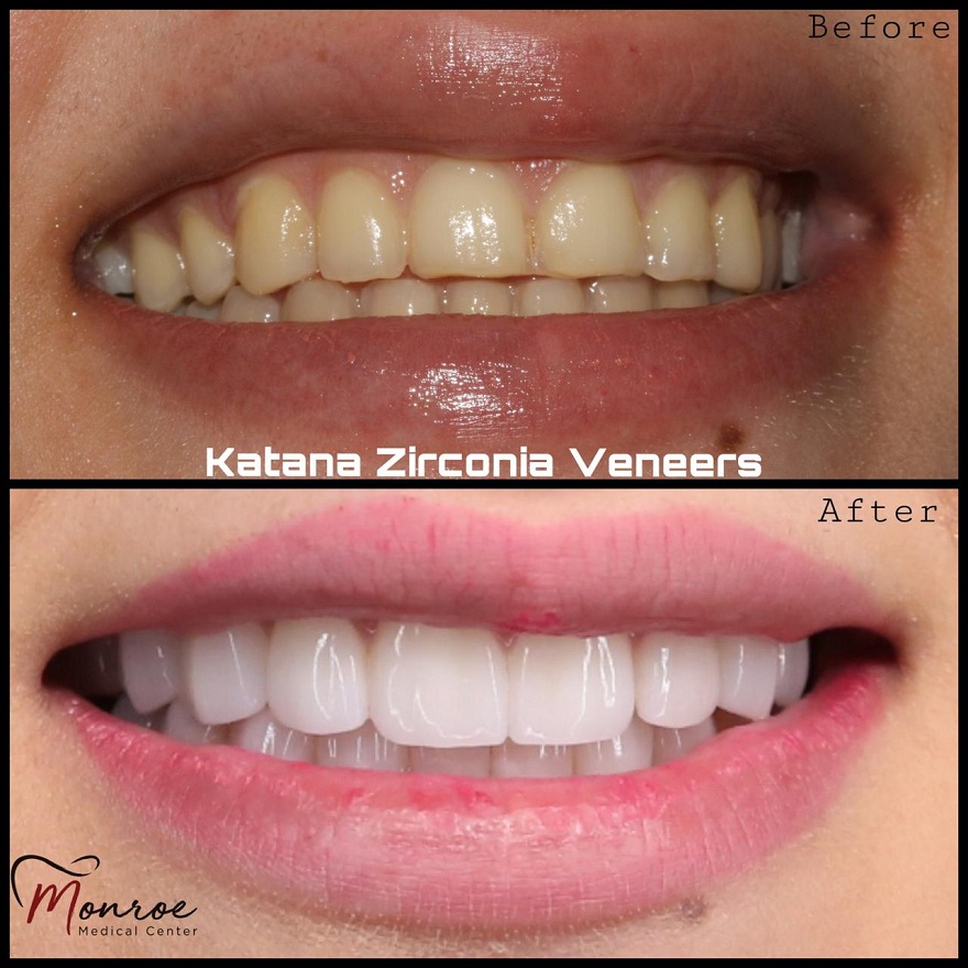 Zirconia Veneers Expat Aktuell