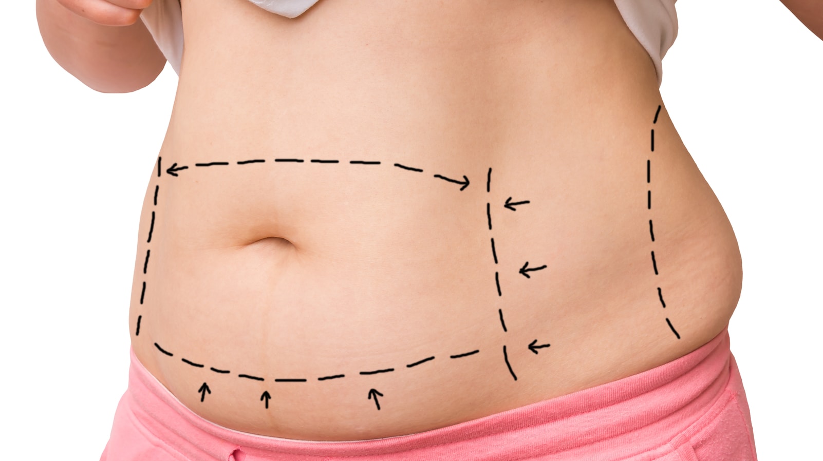 Tummy Tuck Cost in Bangalore Find the Best Surgeons, Reviews and Book