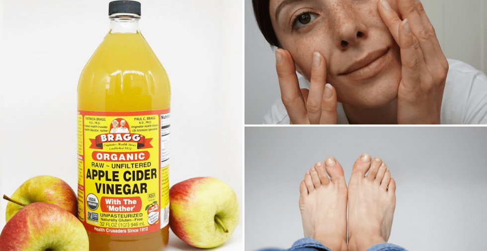 48 EXTRAORDINARY Apple Cider Vinegar Benefits (For Skin, Hair & Pets