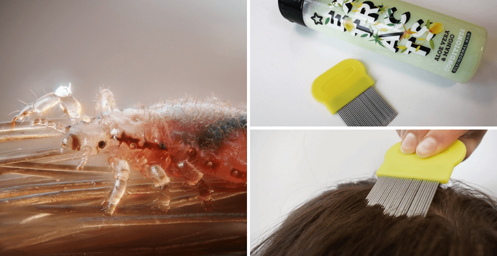 How To Get Rid Of Lice At Home Howto Wiki