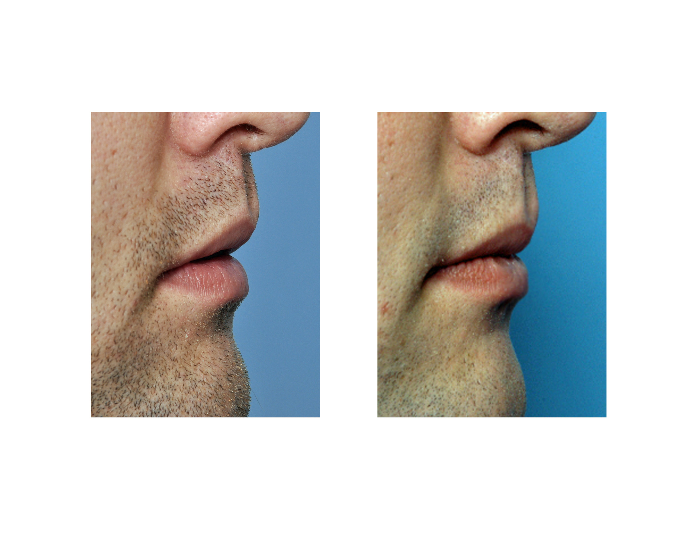 Case Study Lip Reduction for Dry Lips Explore Plastic Surgery