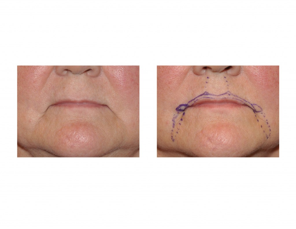 corner of mouth lift Archives Page 2 of 3
