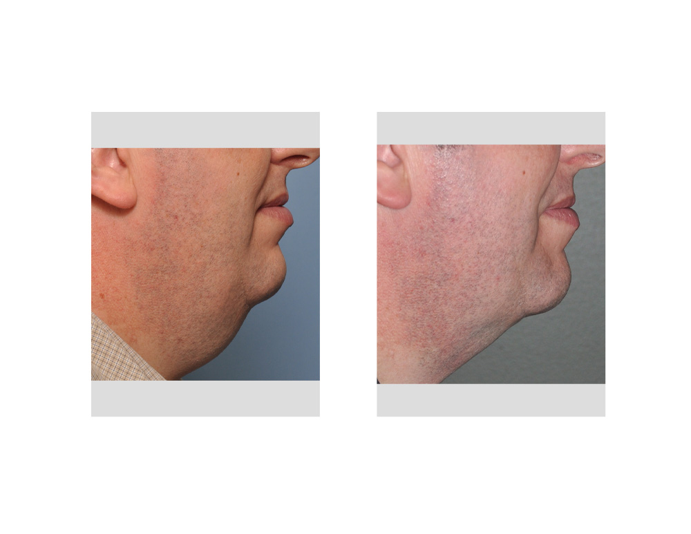 Case Study Liposuction of the Large Male Neck Explore Plastic Surgery