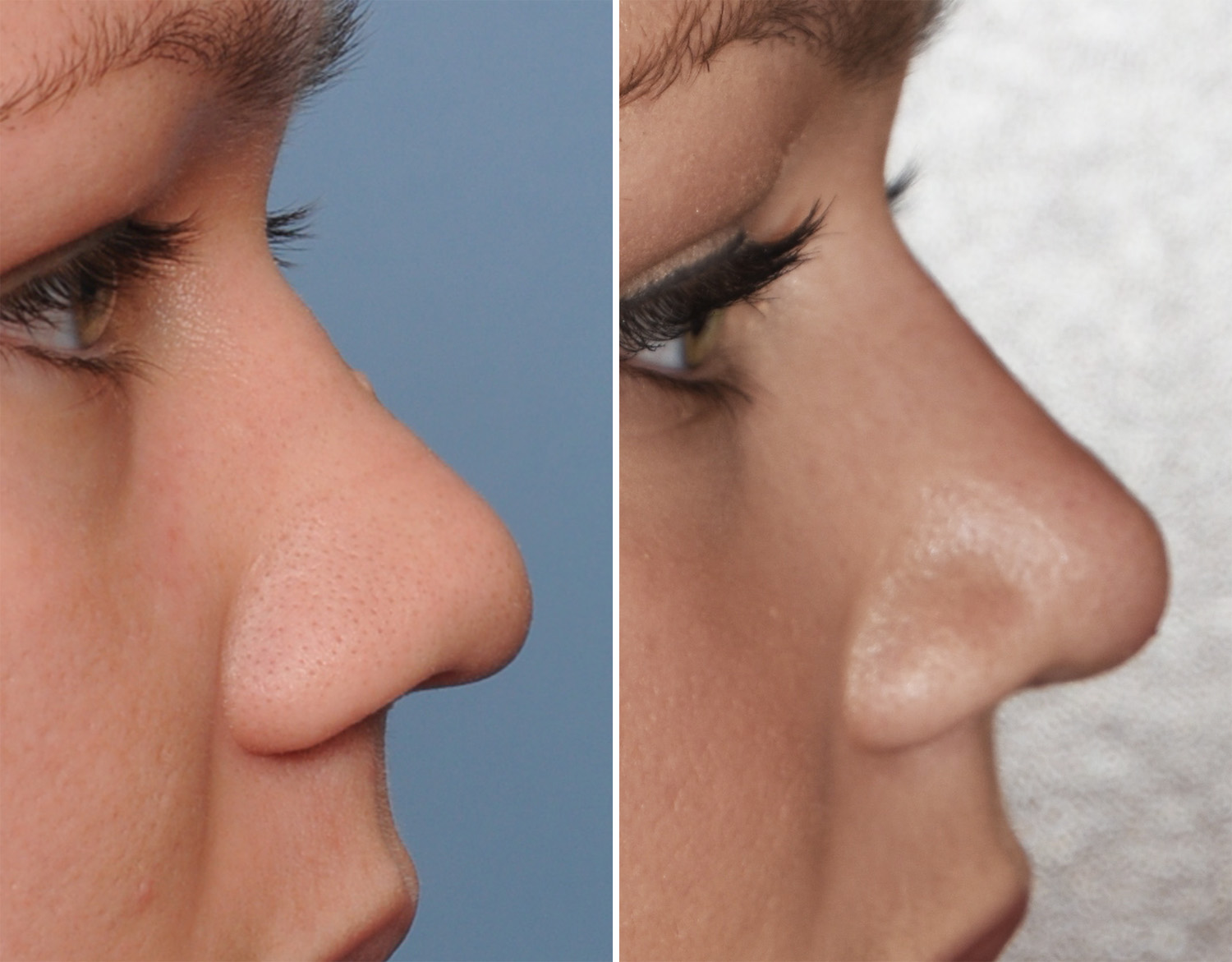 Plastic Surgery Case Study Narrowing in the Wide Nose Rhinoplasty
