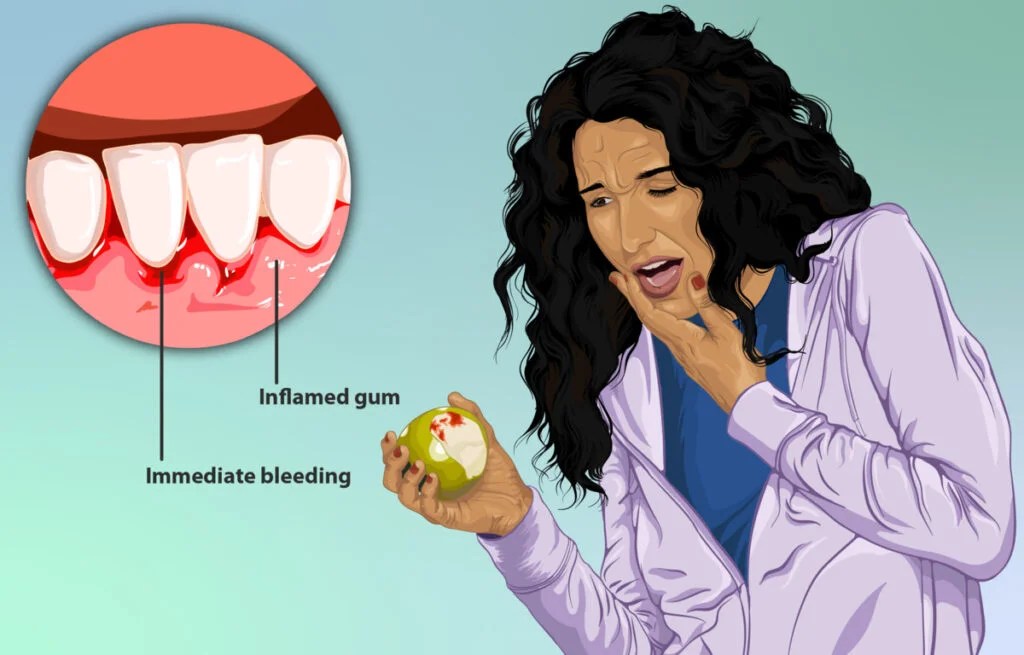 Why Do My Gums Bleed When I Brush My Teeth? Express Dentist