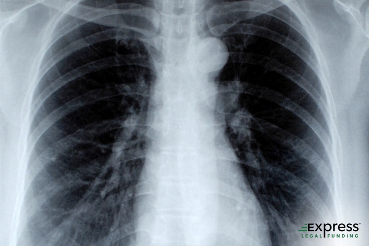 Rib Fracture Accident Treatment, Recovery, and Legal Recourse