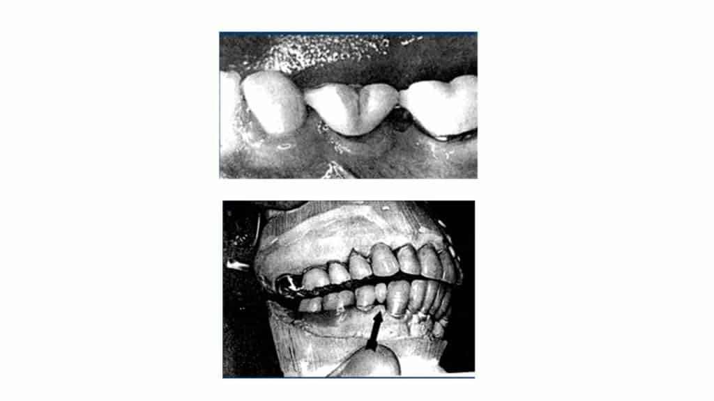 KNOW SELECTION CRITERIA FOR PONTIC AND DESIGNS! extooth