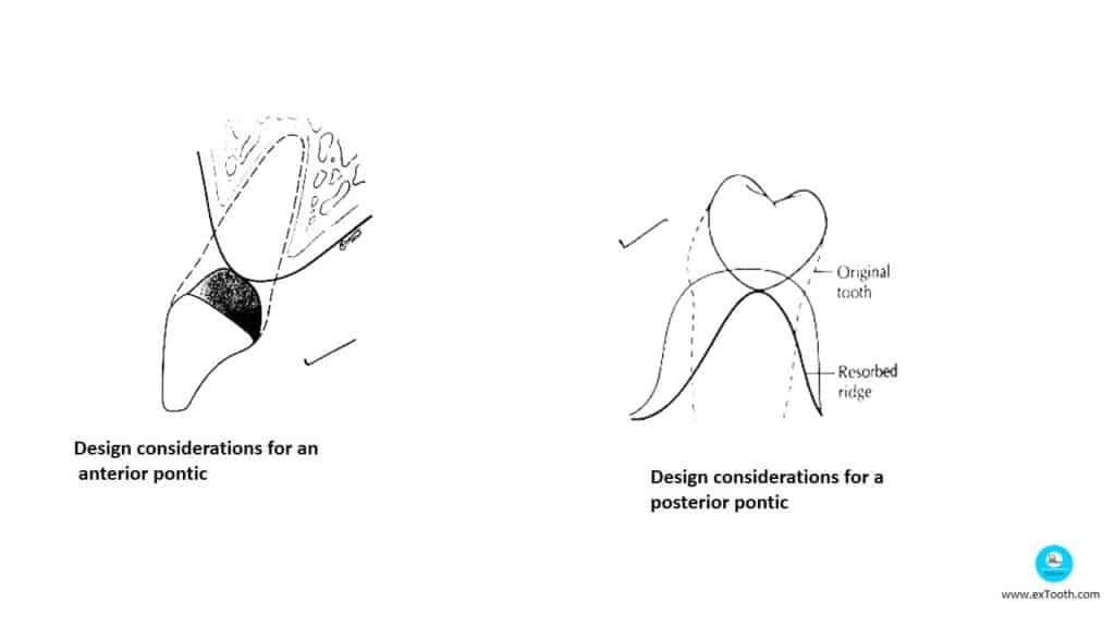KNOW SELECTION CRITERIA FOR PONTIC AND DESIGNS! extooth