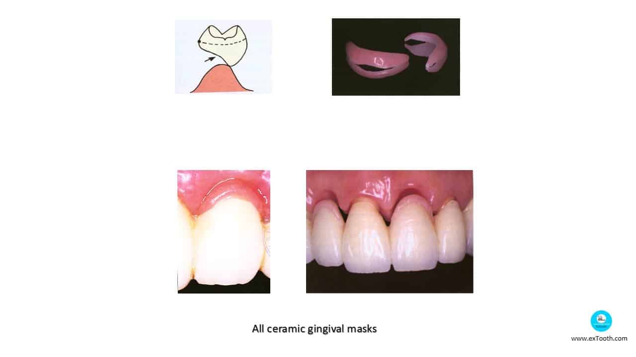KNOW SELECTION CRITERIA FOR PONTIC AND DESIGNS! extooth
