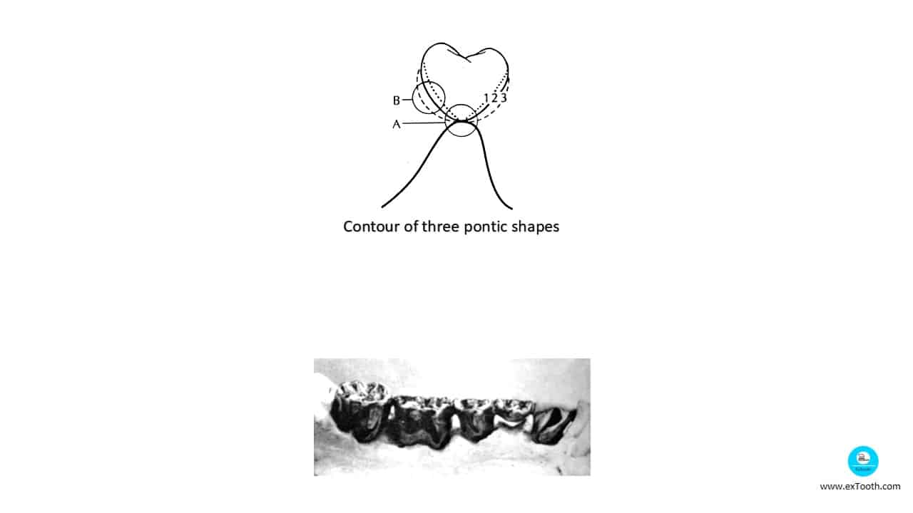 KNOW SELECTION CRITERIA FOR PONTIC AND DESIGNS! extooth