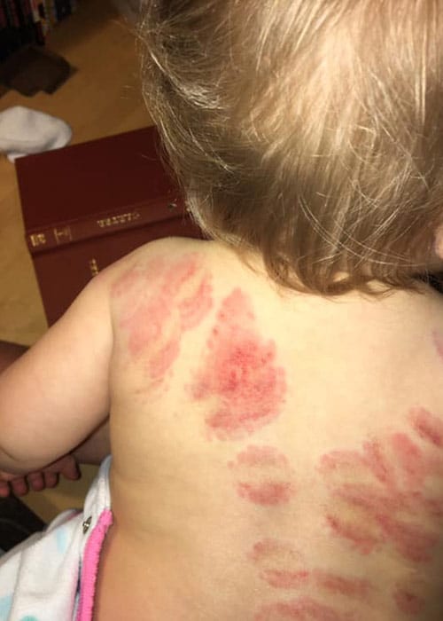 Mum horrified as daughter covered in ‘25 bite marks' after collecting