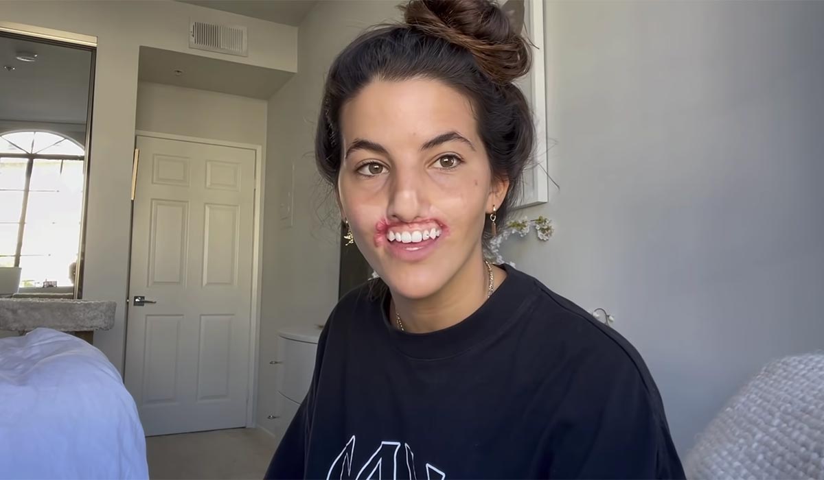 Watch Vogue model's journey to restore smile after top lip ripped off