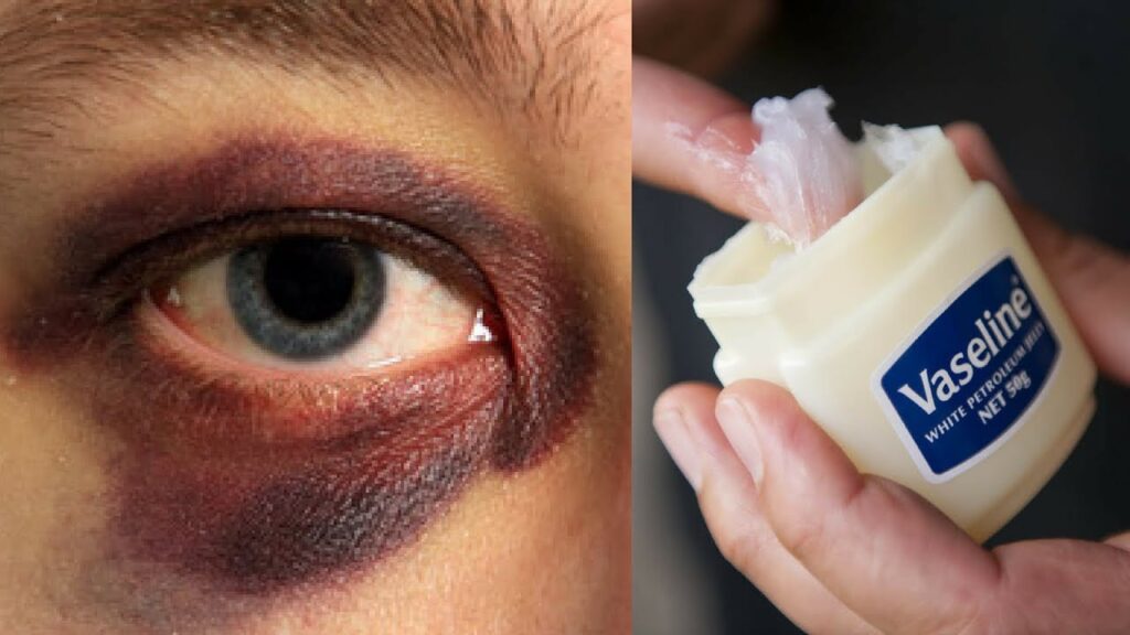 How to Remove Dark Circles with Vaseline Naturally in 3 Days (100