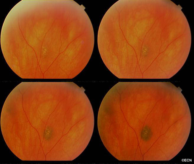 Case 5 Lighting and a Choroidal Nevus » New York Eye Cancer Center