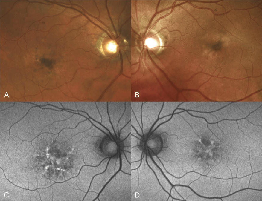 Eye Cancer Foundation Fellow Publishes Study on Chemotherapy Side