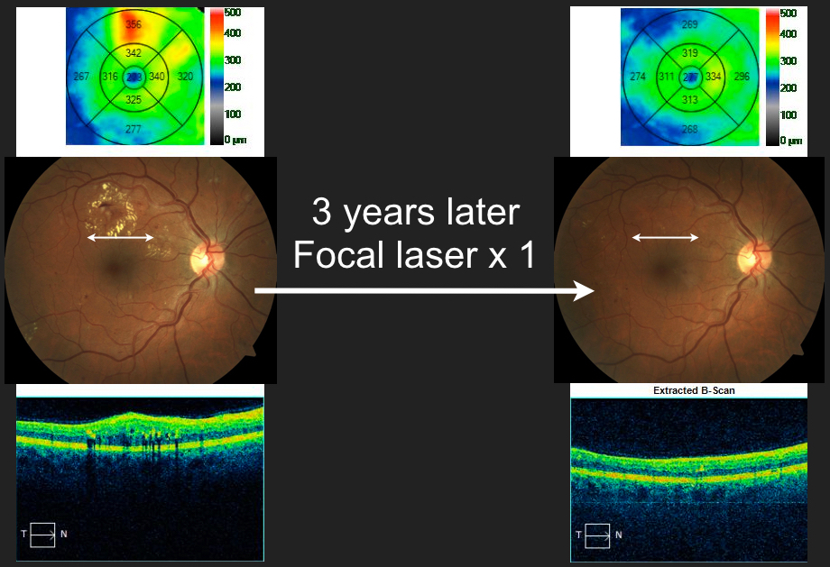 Clinically Significant Macular Edema