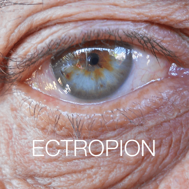 Ectropion & Entropion Eyecare Virginia Beach