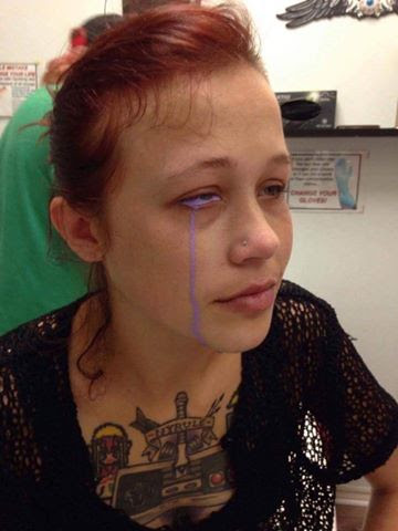 After Eyeball Tattoo, Model Is Partially Blind, In 'Excruciating' Pain - Cynthia J. Mackay, M. D., Ophthalmologist Cynthia J. Mackay, M. D., Ophthalmologist 480_x_360_jpg