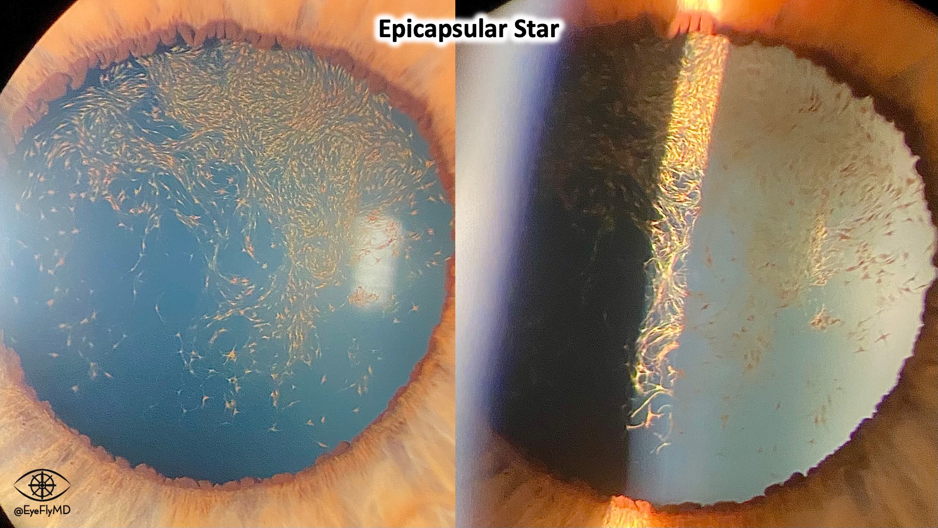 Interesting Cases and Pictures Eye Fly MD