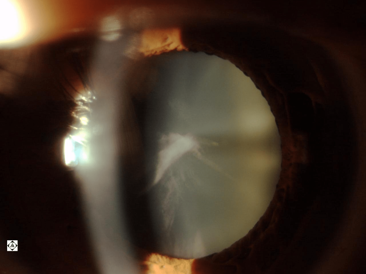 Cortical Cataract
