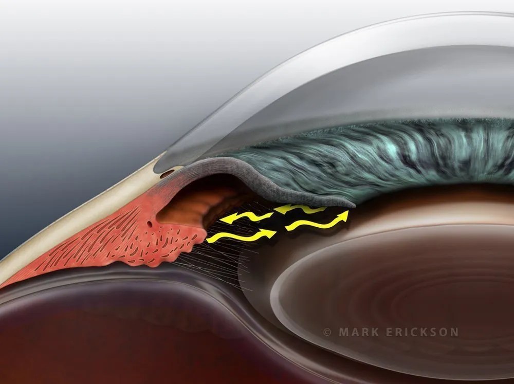 Narrow angle with aqueous flow patient education eye illustration