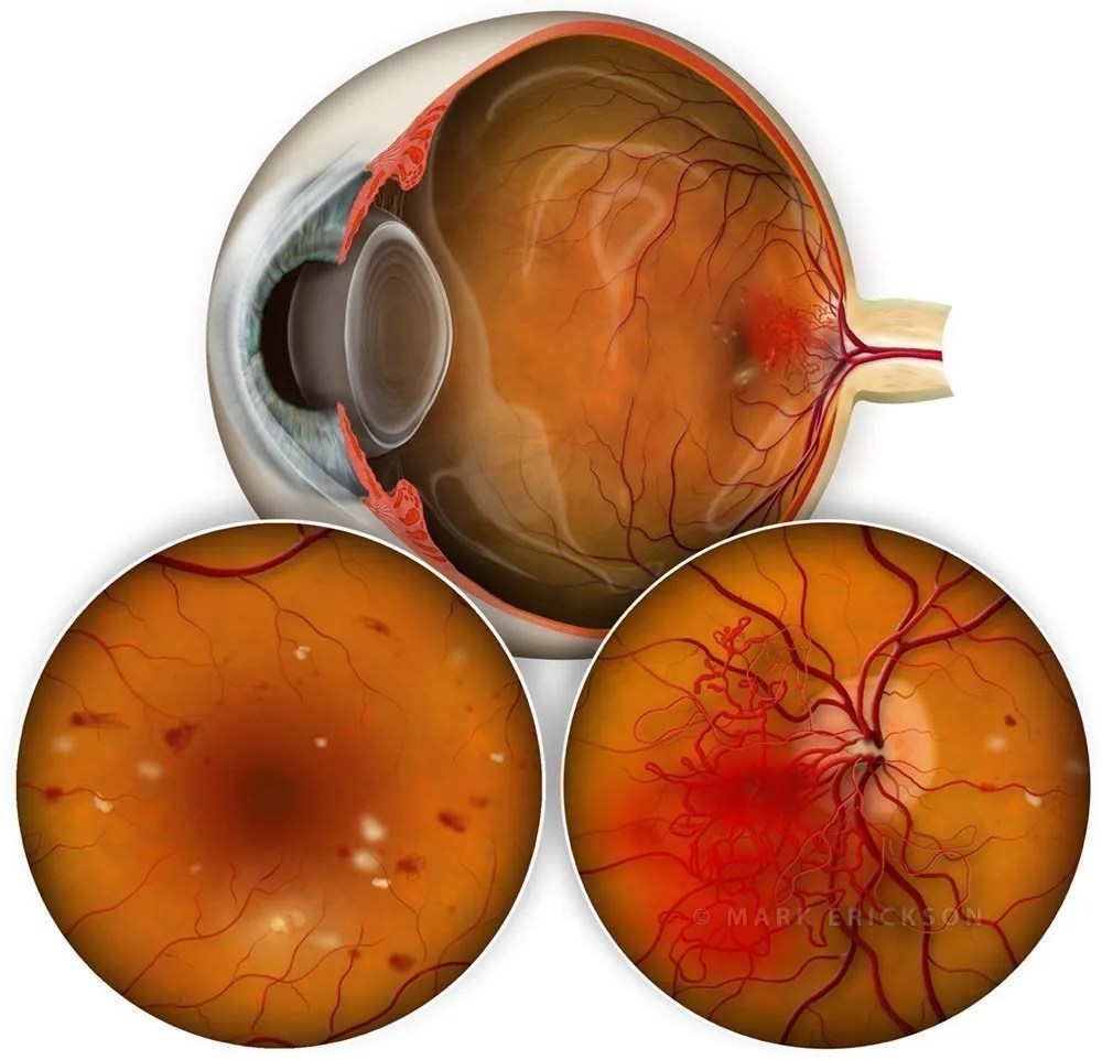 Proliferative diabetic retinopathy with neovascularization of the disc