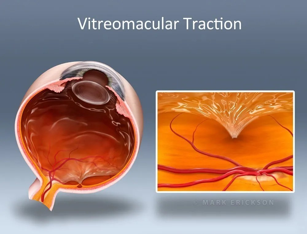 Vitreomacular traction schematic explainer illustration