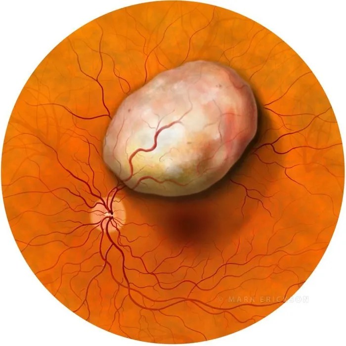Retinoblastoma eye tumor white masses in the retina, eye illustration
