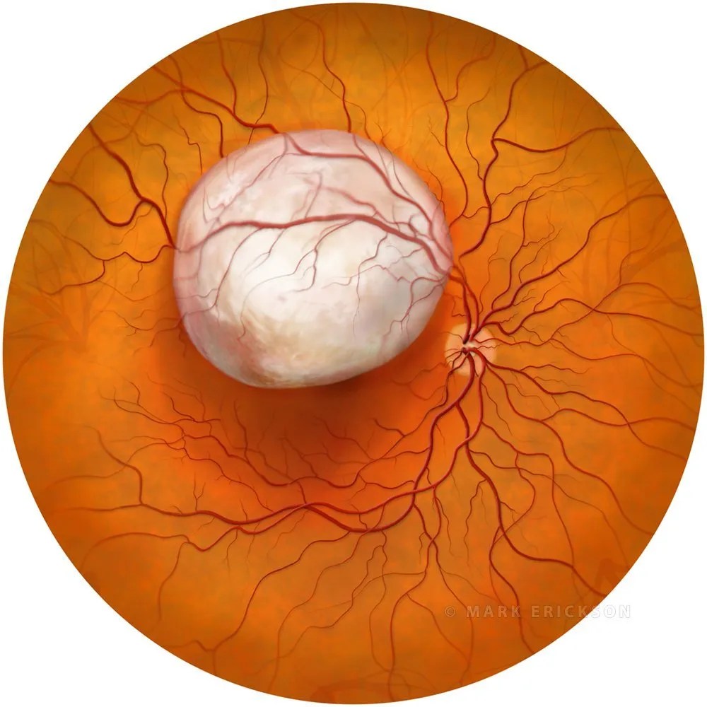 Retinoblastoma cancerous tumor on the retina, medical illustration