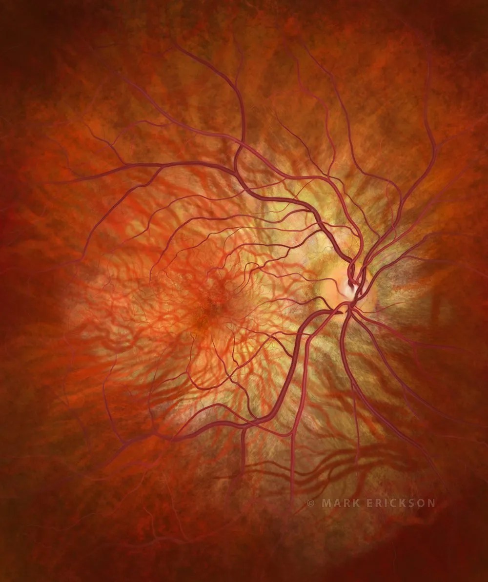Leber congenital amaurosis (LCA) inherited retinal dystrophy
