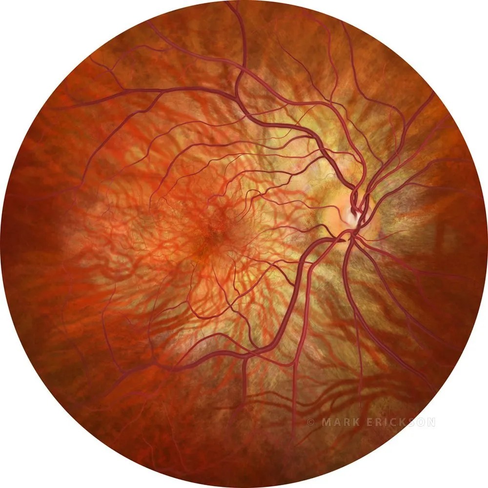 Leber congenital amaurosis retinal dystrophy fundus perspective