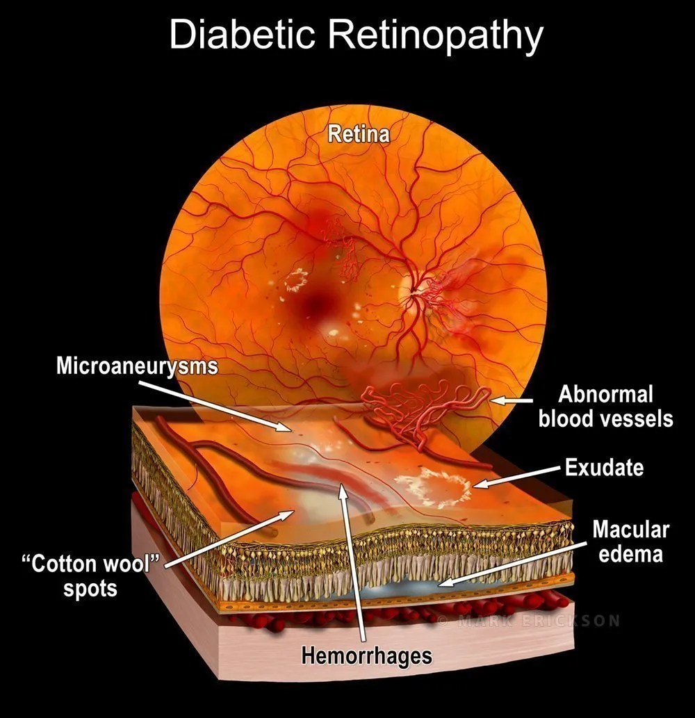Diabetic retinopathy findings with retina crosssection schematic