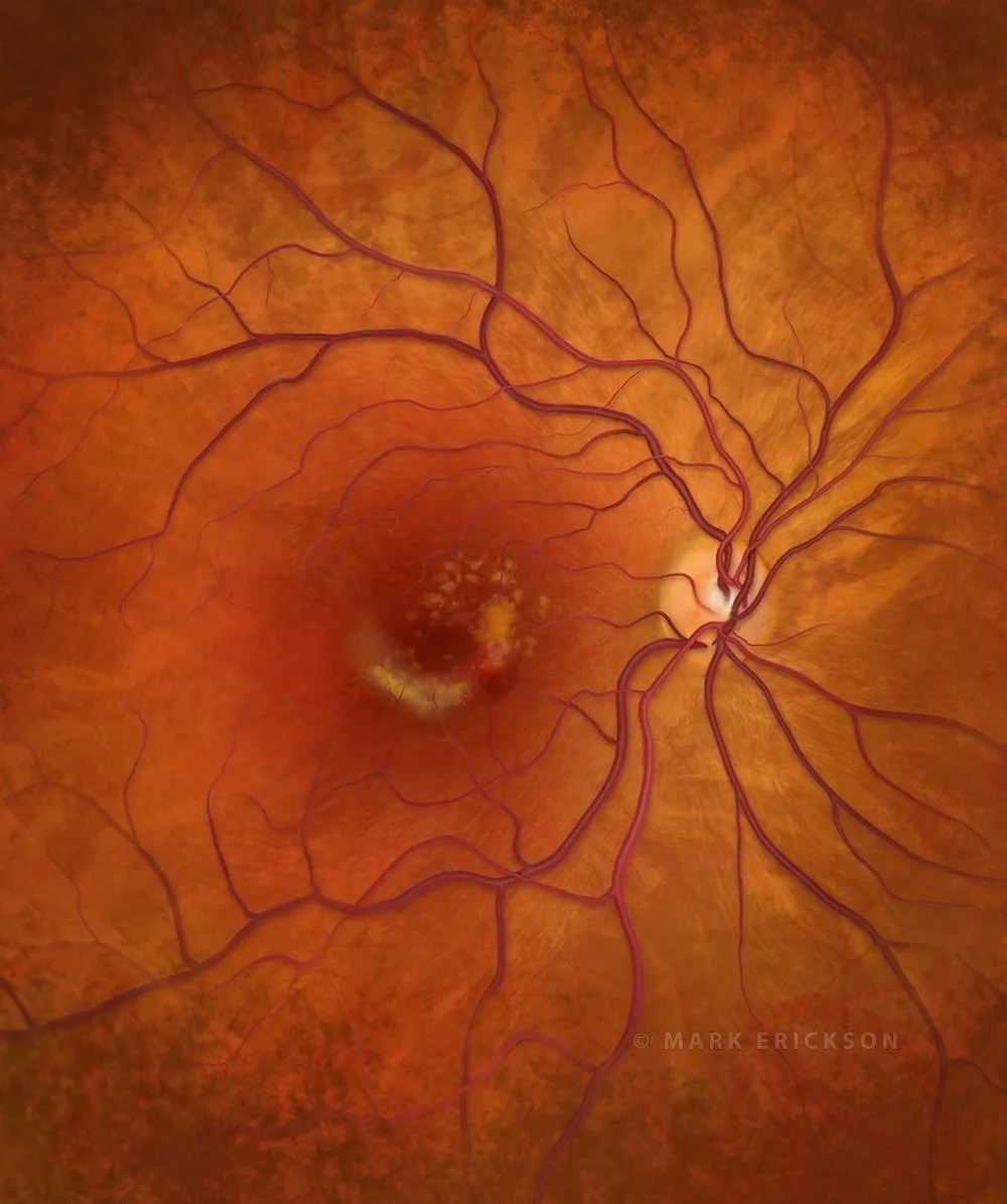 Wet macular degeneration patient education illustration
