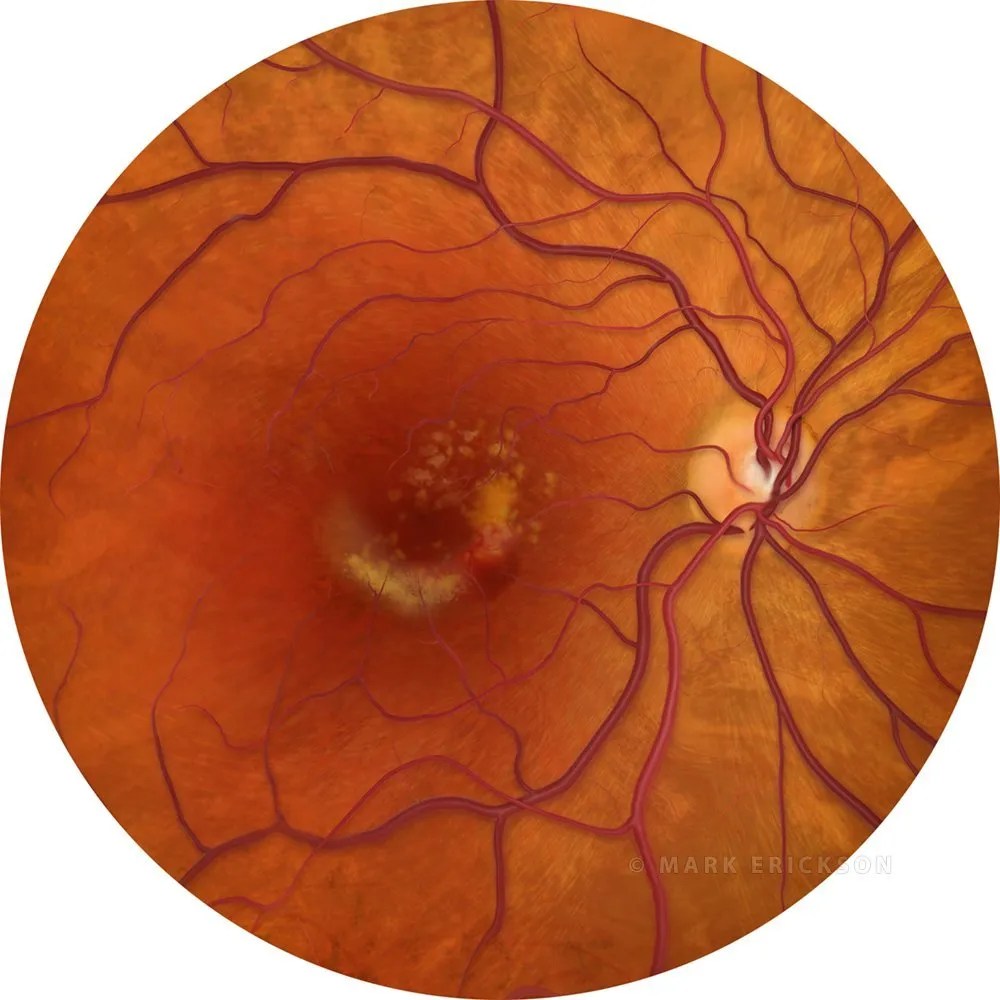 Exudative macular degeneration patient education illustration