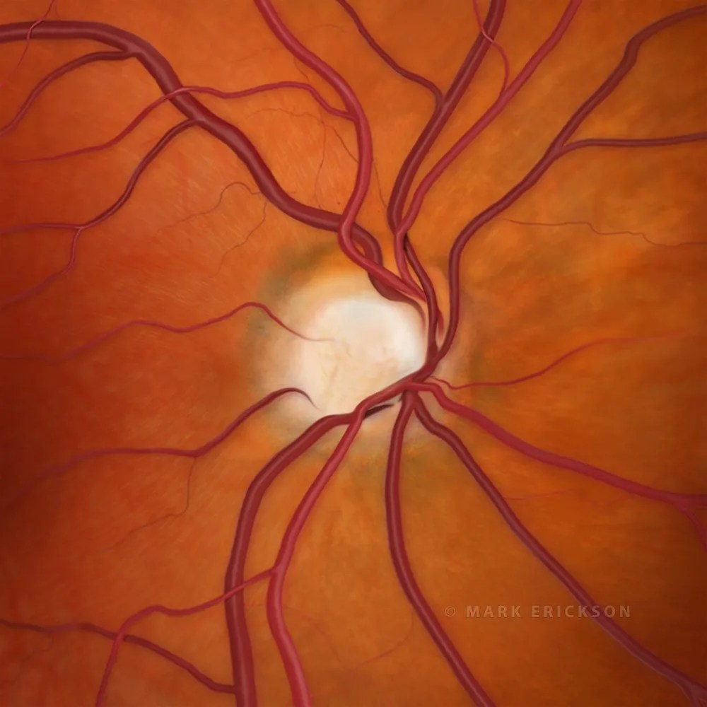 Optic nerve cupping in 0.9 c/d ratio, illustration