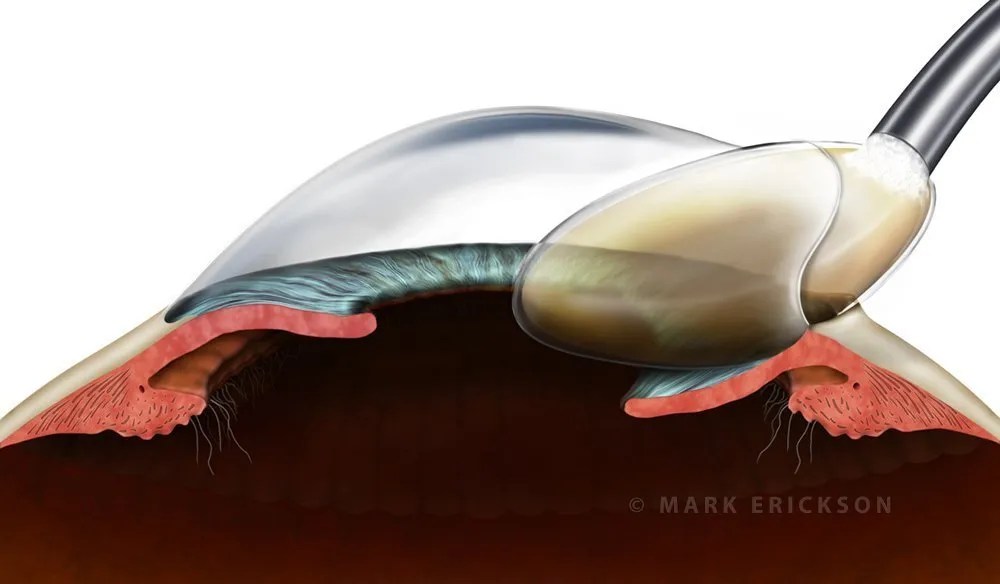 Cryoextraction in intracapsular cataract extraction (ICCE)