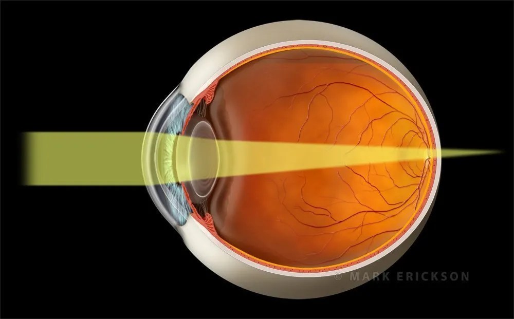 Hyperopic refractive error with light rays focusing past the retina surface