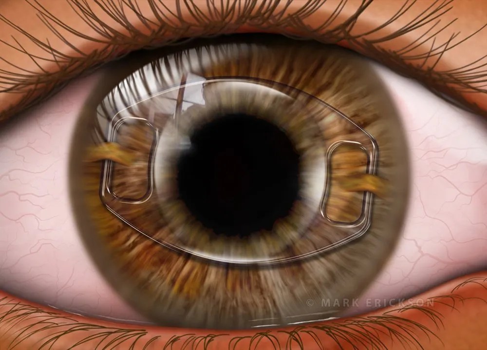 Iris fixated intraocular lens IOL implantation