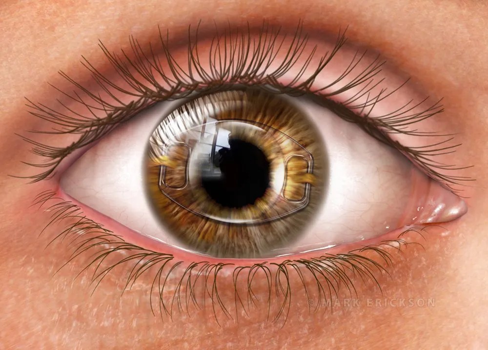 Iris fixated IOL intraocular lens implant refractive surgery