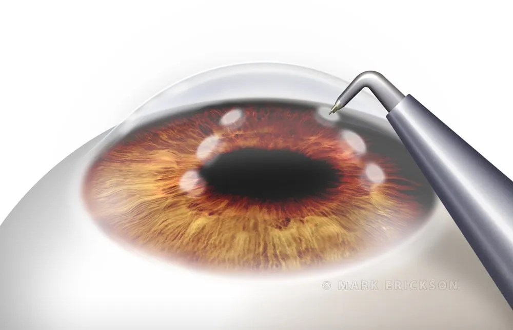 Conductive keratoplasty (CK) refractive laser eye surgery illustration