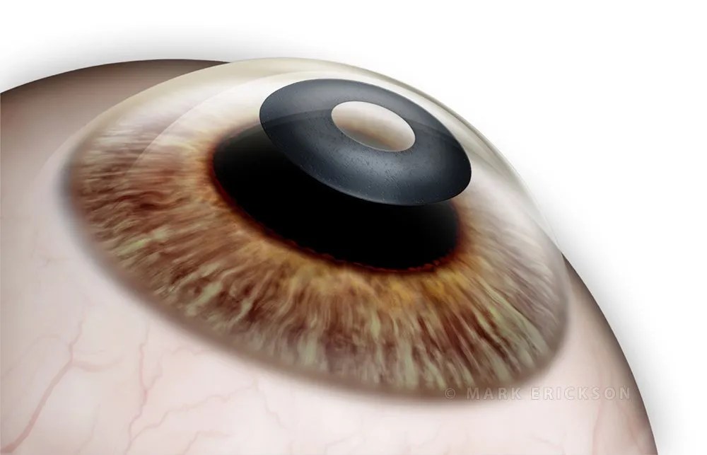 Kamra corneal inlay implant for treatment of presbyopia, refractive surgery