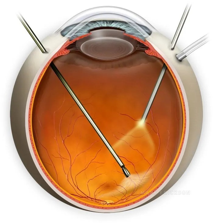 Epiretinal membrane peel, vitreoretinal surgery illustration